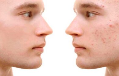 ¡Que tu rostro no quede marcado por el acné!